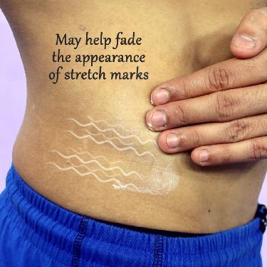 Stretch Marks Repair Cream (SMRC2)